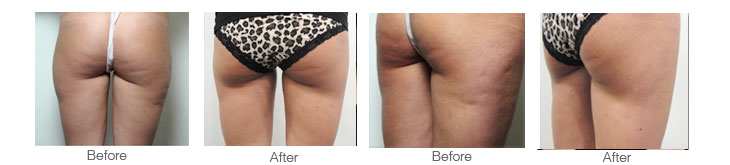 before and after photograph showing results of laser lipo to the thigh areas